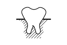 Undiagnosed periodontal disease (gum disease)